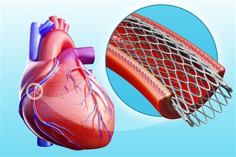 Heart Stent Procedure Videos for Blocked Operation