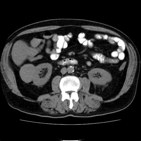 Renal cell carcinoma CT - wikidoc