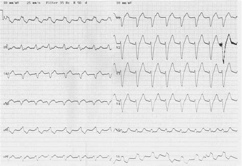 Twelve-lead ECG showing accelerated idioventricular rhythm in a patient ...