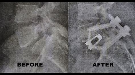 2 week post op L5-S1 Spinal Fusion - YouTube