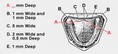 Posterior Palatal Seal Flashcards | Quizlet