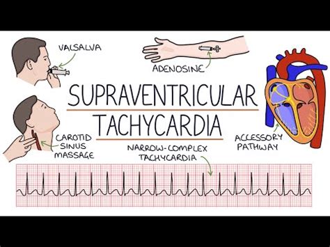 Supraventricular Extrasystole - Symptoms And Treatment | Diseases and ...