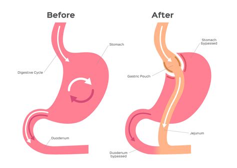 Gastric Bypass vs. Gastric Sleeve: Which One Is Right for You?