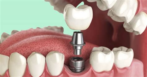 A Guide to Healing Abutments - Brighton Implant Clinic : Dental Implants