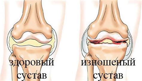 Causes, symptoms of arthrosis, its complications and treatment methods ...