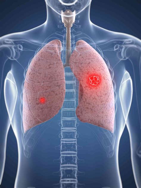 Trastornos de la cavidad pleural - Medicina Básica