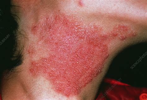 Fungal skin infection - Stock Image M270/0208 - Science Photo Library