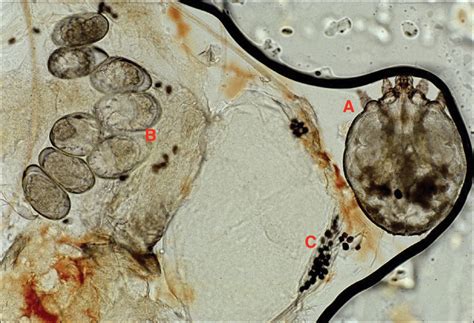 What’s Eating You? Scabies in the Developing World | MDedge Dermatology