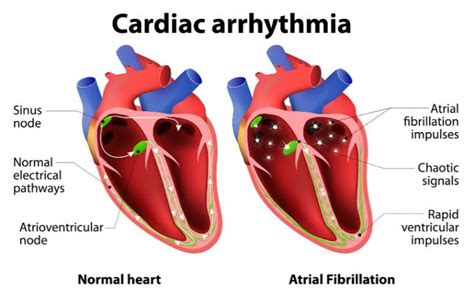 Arrhythmia Home Remedy Treatment - Home Remedy And Natural Cures