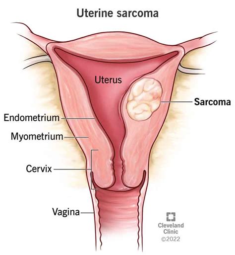 Uterine Sarcoma: Symptoms, Diagnosis, Treatment & Prevention