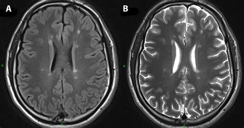 Axial FLAIR (left) and T2 (right) brain MRI show multiple lesions ...