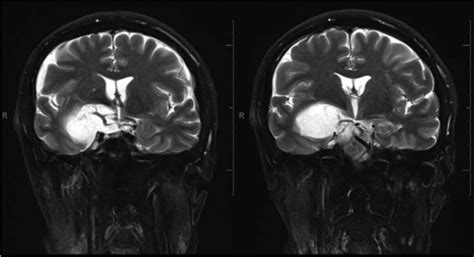 Magnetic resonance imaging (MRI) coronal view. The lesion invades the ...