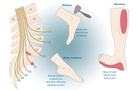 47+ Spine L5-S1 Diagram - KareemDixie