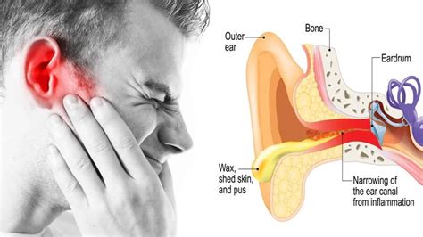 How To Help Swimmers Ear Pain - Cares Healthy