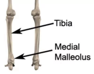 Medial Malleolus Fracture - Fractured Medial Malleolus - PhysioAdvisor