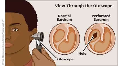 A to Z: Eardrum, Perforated (for Parents) - Humana - Louisiana