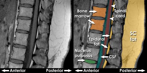 Lumbar Spine Mri Interpretation