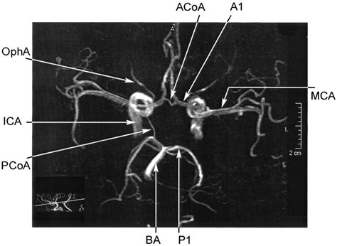 MRA Brain anatomy | Radiology Anatomy Images | Brain anatomy, Anatomy ...