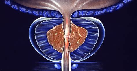 GreenLight Laser Prostate Surgery for BPH - Enlarged Prostate