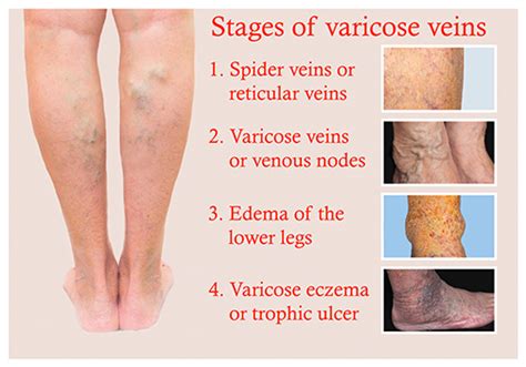 Symptoms Caused by Varicose Veins | Atlanta Vascular & Vein Centers