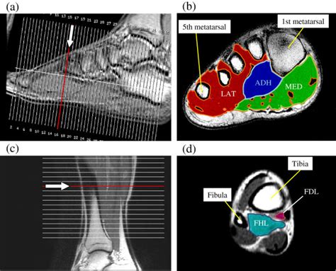 Mri Plantar Foot Anatomy Muscles