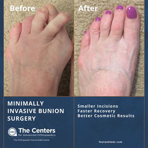 Bunion Surgery: Symptoms, Causes, Diagnosis Treatment,, 51% OFF