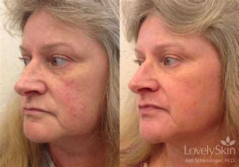 Omaha Dermatology - Rosacea Treatments | Skin Specialists PC