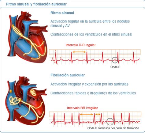 America Artista Inolvidable arritmia cardiaca fibrilacion auricular ...