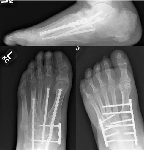 Charcot Foot Reconstruction