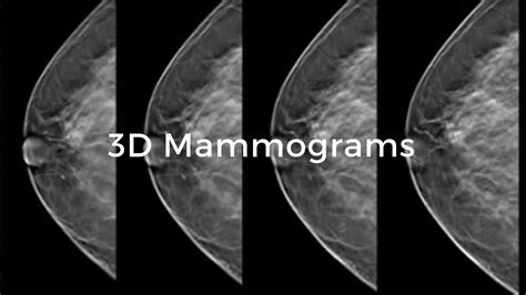 What is a 3d Mammogram? | Hill Regional Hospital