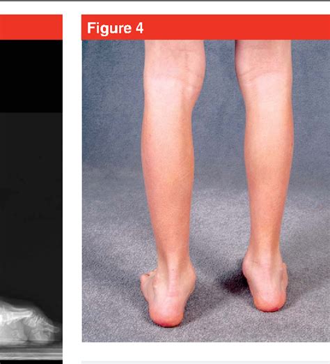 Congenital Vertical Talus: Etiology and Management | Semantic Scholar