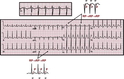 Supraventricular Arrhythmias: Clinical Framework and Common Scenarios ...