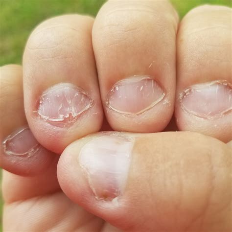 Causes of Fingernail Fungus | Forces of Nature Medicine