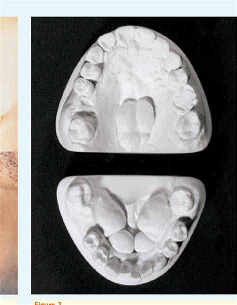 Pronounced Palatal and Mandibular Tori Observed in Patient With Chronic ...