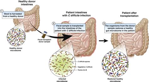 Fecal Transplant: Principle, Procedure, Uses • Microbe Online