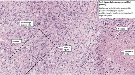 Thigh – Leiomyosarcoma – NUS Pathweb :: NUS Pathweb