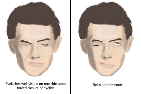 Facial palsy causes – Telegraph