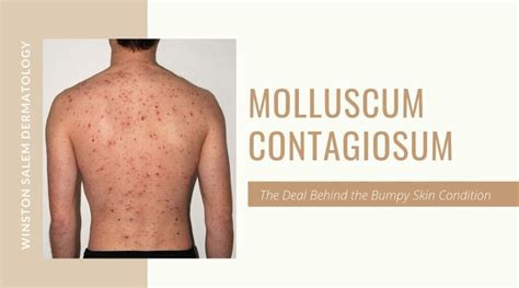 Molluscum Contagiosum, The Deal Behind Raising Bumps on Skin