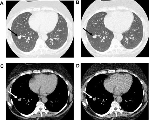 Low-dose CT Scans are game changer in diagnosis - Healthcare Radius