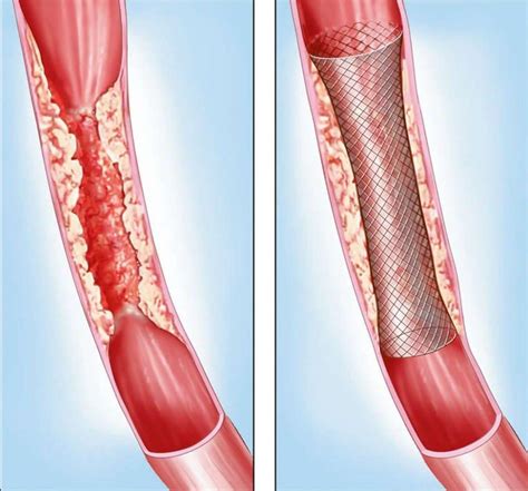 Stenting - Bel Air, MD & Towson, MD: Vascular Surgery Associates, LLC