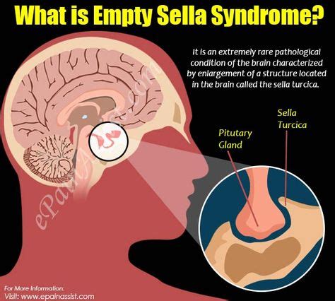 Empty Sella Syndrome