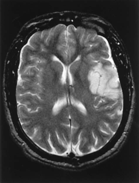 Measurement of Infarct Size Using MRI Predicts Prognosis in Middle ...