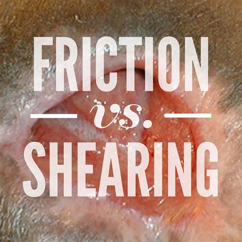 Friction vs. Shearing in Wound Care: What's the Difference? - WCEI ...