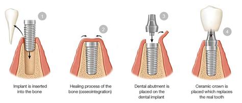 How Does a Dental Implant Work? | NYC Dental Implants Center