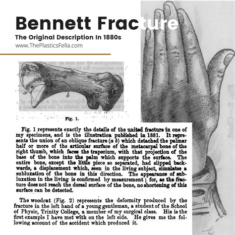 Bennett Fracture - X-Rays, Diagnosis, Treatment.