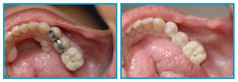 Composite Fillings Scarsdale, NY | Scarsdale Dental Group