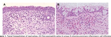 Changes in Histological Features of Nasal Polyps in a Korean Population ...