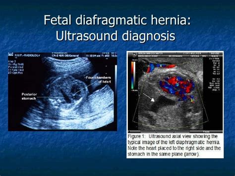 Congenital Diaphragmatic Hernia Ultrasound