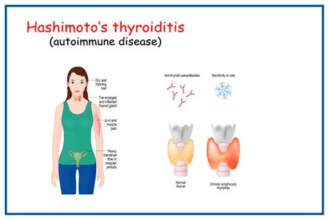 Managing The Symptoms Of Hashimoto's Thyroiditis - Ask The Nurse Expert