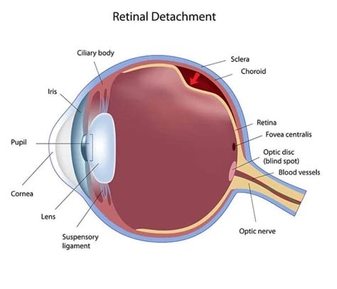 Retina Tears & Detachment - Center For Vitreo-Retinal Diseases